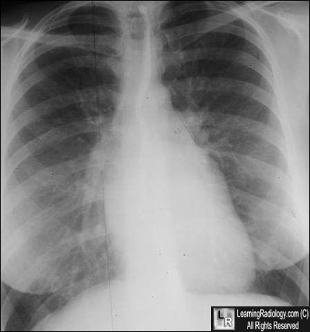 Mitral Stenosis